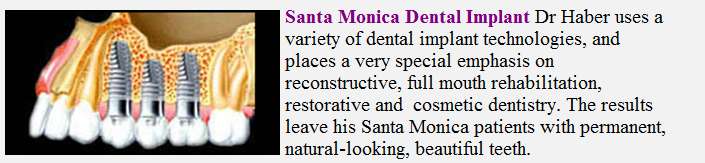 santa monicadental implant