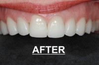 porcelain veneers