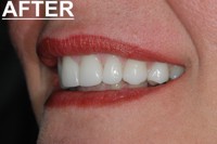 porcelain veneers